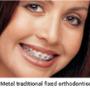 Traditional Braces