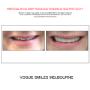 Grab a huge Saving with our PREPLESS OR NO-PREP Porcelain Veneer Specials and Packages