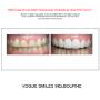 Grab a huge Saving with our PREPLESS OR NO-PREP Porcelain Veneer Specials and Packages