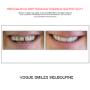 Grab a huge Saving with our PREPLESS OR NO-PREP Porcelain Veneer Specials and Packages