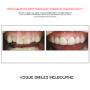Grab a huge Saving with our PREPLESS OR NO-PREP Porcelain Veneer Specials and Packages