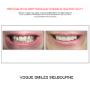 Grab a huge Saving with our PREPLESS OR NO-PREP Porcelain Veneer Specials and Packages
