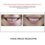 Grab a huge Saving with our PREPLESS OR NO-PREP Porcelain Veneer Specials and Packages