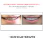 Grab a huge Saving with our PREPLESS OR NO-PREP Porcelain Veneer Specials and Packages