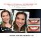 PREPLESS-porcelain-veneer