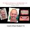 PREPLESS-porcelain-veneer