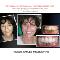 PREPLESS-porcelain-veneer