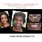 PREPLESS-porcelain-veneer