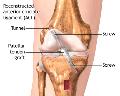 ACL Reconstruction
