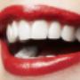porcelain-veneers