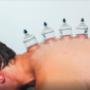 Melbourne Natural Therapies cupping.