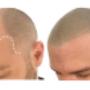 Before and after Smp treatment