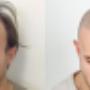 Scalp Micropigmentation Before and After