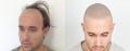 Scalp Micropigmentation Treatment Special!