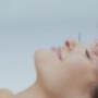 Acupuncture