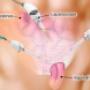 Hernia Surgery