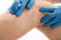 Spider Veins Treatment