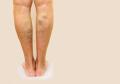 Varicose Veins Treatment
