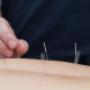 Acupuncture