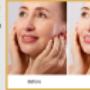 facelift