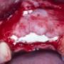 Bone Augmentation Surgery