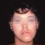 Facial Trauma