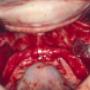 Sinus Lift Surgery