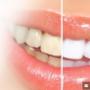 Teeth Whitening