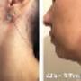 Skin Tightening