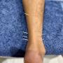 Dry Needling