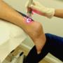 Heel Pain Laser