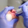 Wart treatment