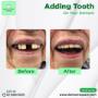 Denture Repairs