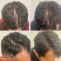 Hair Regrowth Treatment