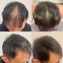 Hair Regrowth