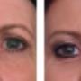 Eyelid
