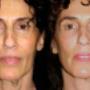 Chin Surgery