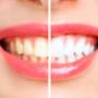 Teeth Whitening