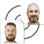 Hair Replacement