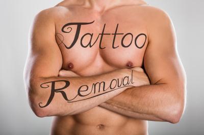 Tattoo-Removal