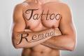 How Does Laser Tattoo Removal Work