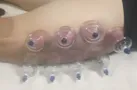 cupping