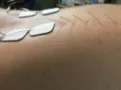 dry needling