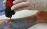 Laser-tattoo-removal-
