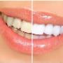teeth whitening dentist