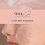 Acne Treatment