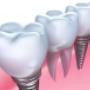dental implants - no gap dentists - sydney