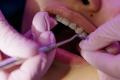 Invisible Braces vs. Metal Braces (Pros and Cons)