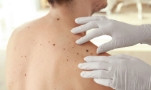 Mole Check Clinic