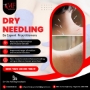 Dry Needling